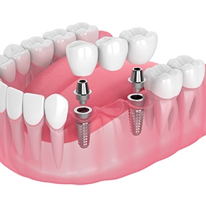 Digital image of implant bridge parts