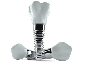 Render of three dental implant posts